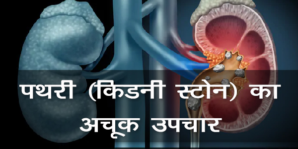 पथरी (किडनी स्टोन) का अचूक उपचार