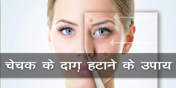 चेचक के दाग़ हटाने के उपाय चेचक के दाग़ हटाने के उपाय