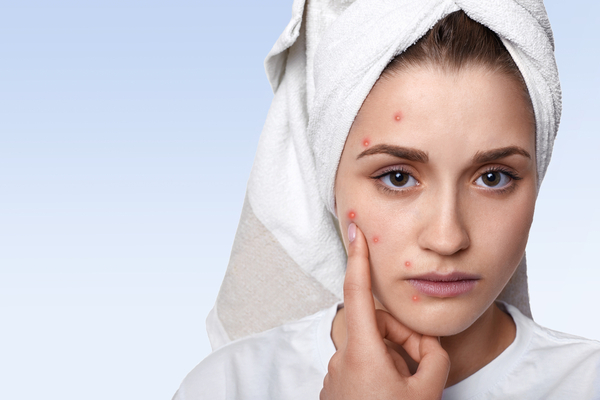 कील-मुँहासे (Acne) से छुटकारा पाने के घरेलू नुस्ख़े