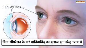 मोतिया बिन्द है तो करें ये घरेलु उपाय