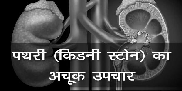 पथरी (किडनी स्टोन) का अचूक उपचार