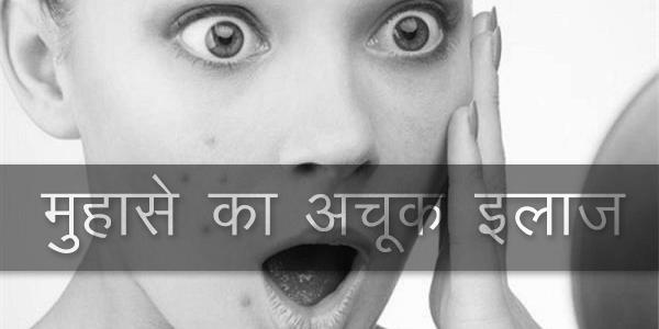 मुहाँसे (पिम्प्प्ल) का अचूक इलाज मुहाँसे (पिम्प्प्ल) का अचूक इलाज