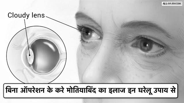 मोतिया बिन्द है तो करें ये घरेलु उपाय