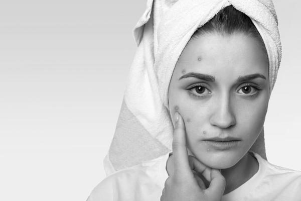 कील-मुँहासे (Acne) से छुटकारा पाने के घरेलू नुस्ख़े